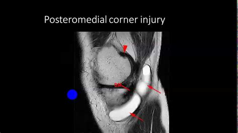 how to test for soft tissue damage|soft tissue injury mri.